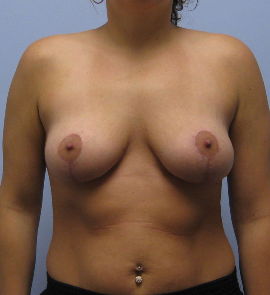 Breast Lift Before & After Image