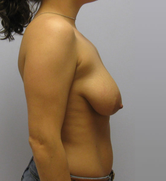 Breast Lift Before & After Image