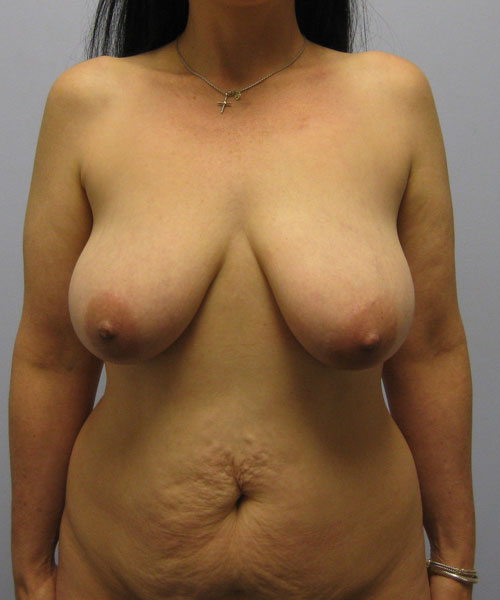 Breast Lift Before & After Image