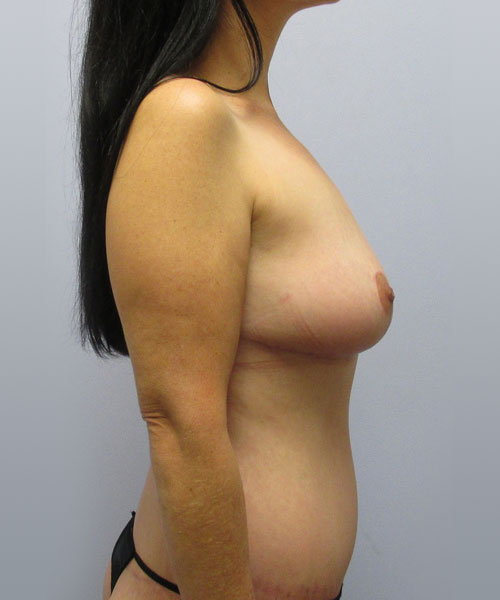 Breast Lift Before & After Image