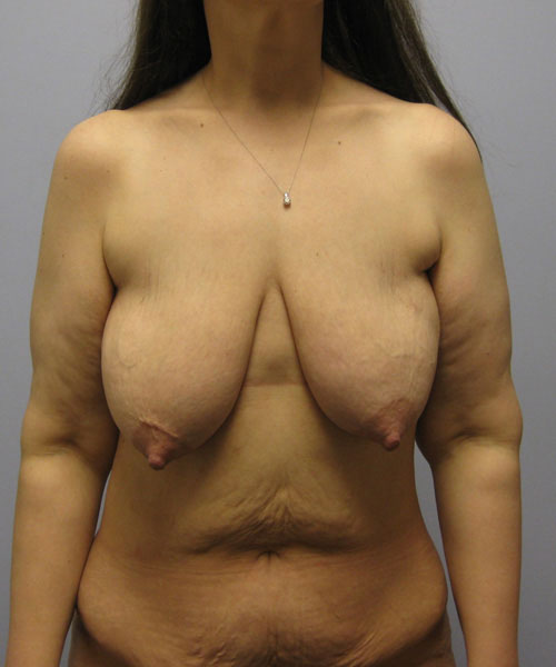 Breast Lift Before & After Image