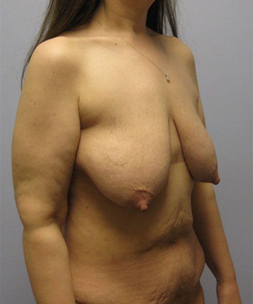 Breast Lift Before & After Image