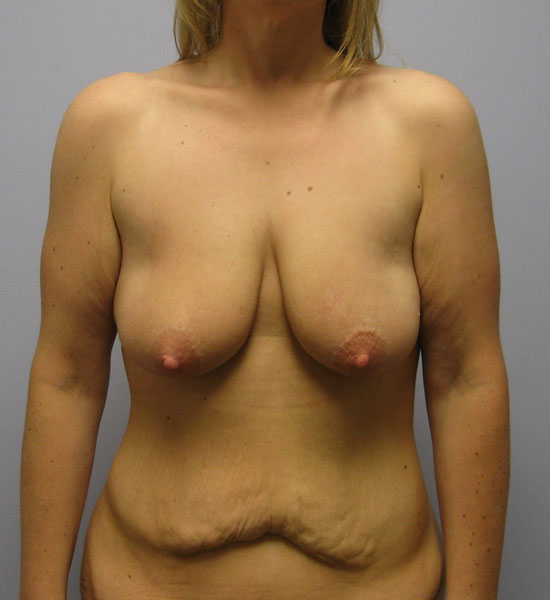 Breast Lift Before & After Image