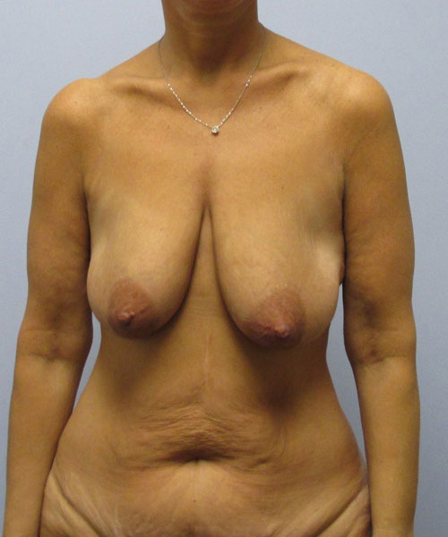 Breast Lift Before & After Image