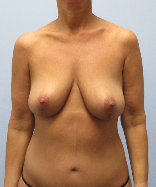 Breast Lift Before & After Image