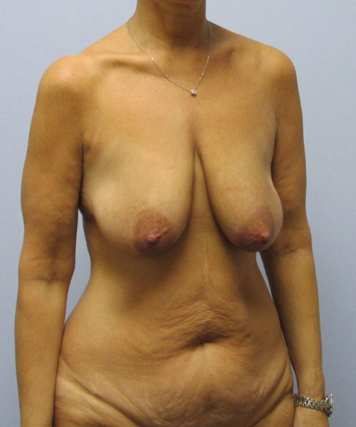 Breast Lift Before & After Image