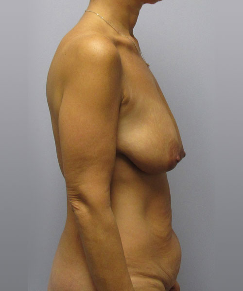 Breast Lift Before & After Image