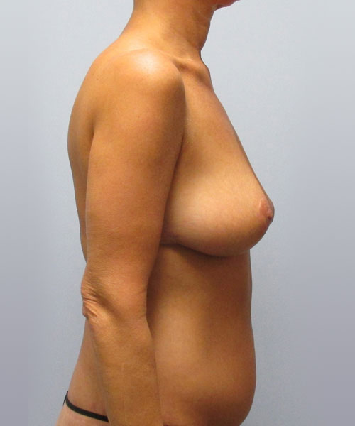 Breast Lift Before & After Image