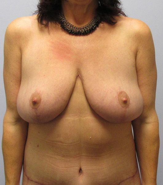 Breast Lift Before & After Image