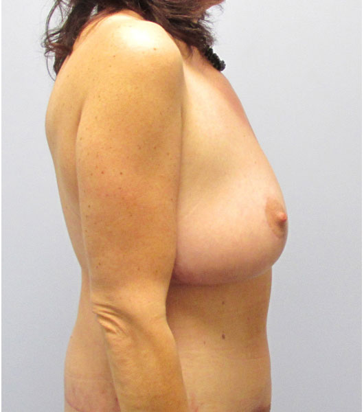 Breast Lift Before & After Image