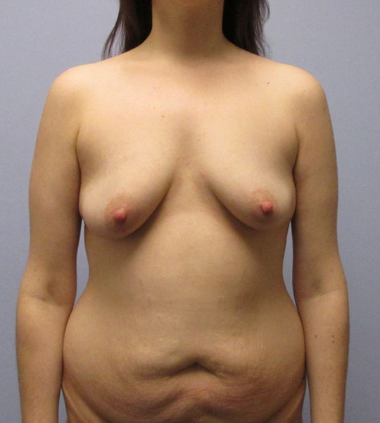 Breast Lift Before & After Image