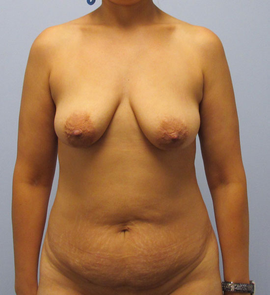 Breast Lift Before & After Image