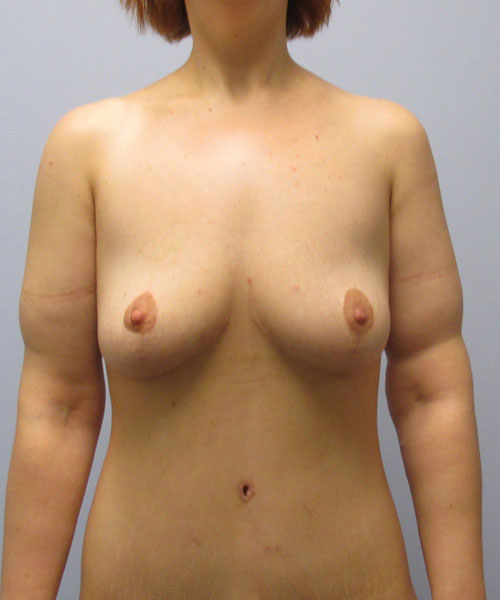 Breast Lift Before & After Image