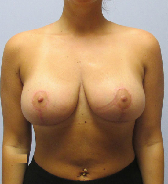 Breast Lift Before & After Image