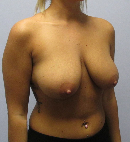 Breast Lift Before & After Image