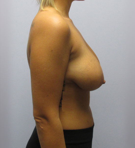 Breast Lift Before & After Image