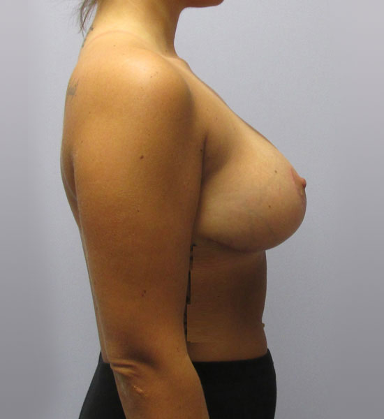 Breast Lift Before & After Image