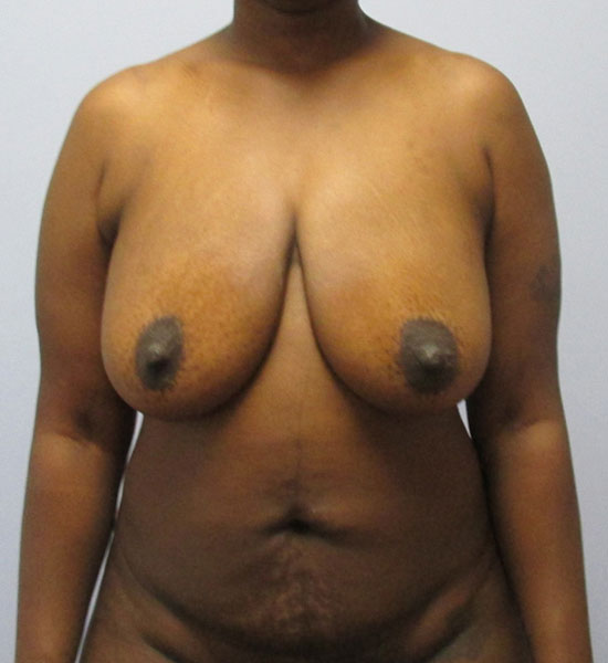 Breast Lift Before & After Image