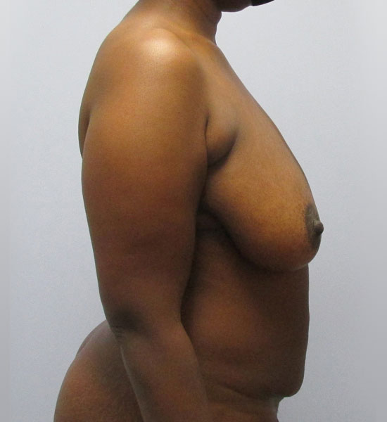 Breast Lift Before & After Image