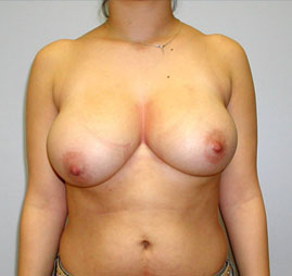 Breast Reduction Before & After Image