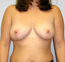 Breast Reduction Before & After Image