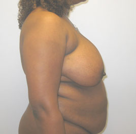 Breast Reduction Before & After Image