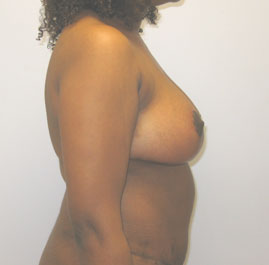 Breast Reduction Before & After Image