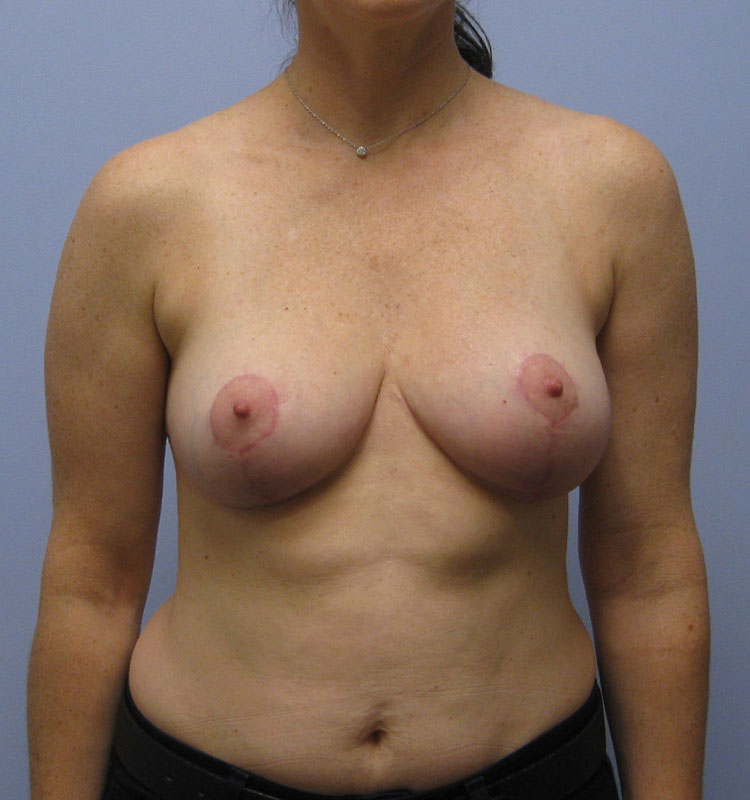 Breast Reduction Before & After Image