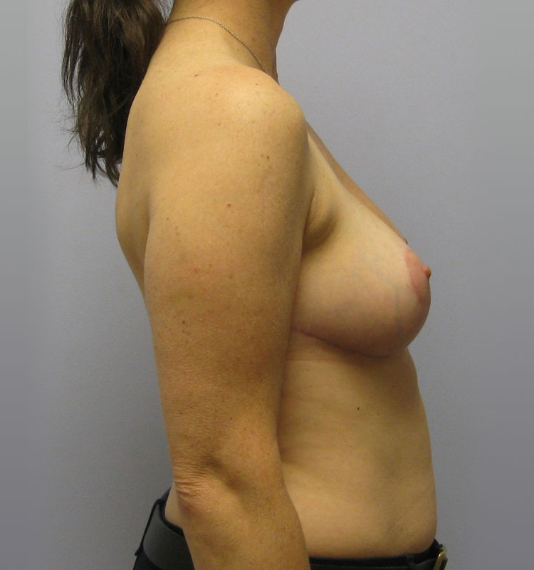 Breast Reduction Before & After Image