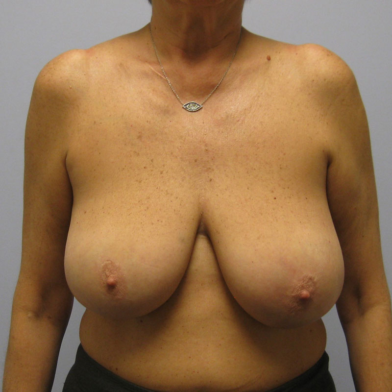 Breast Reduction Before & After Image