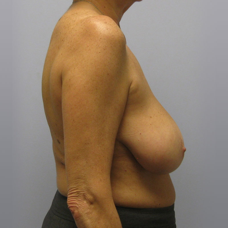 Breast Reduction Before & After Image