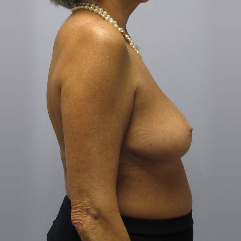 Breast Reduction Before & After Image