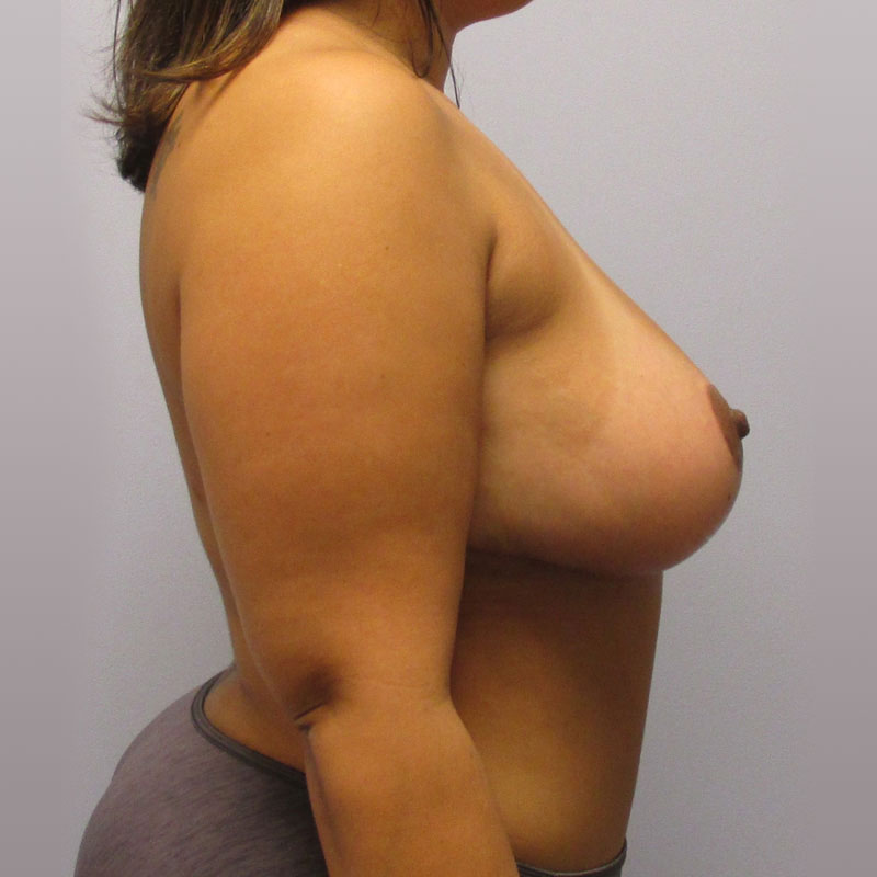 Breast Reduction Before & After Image