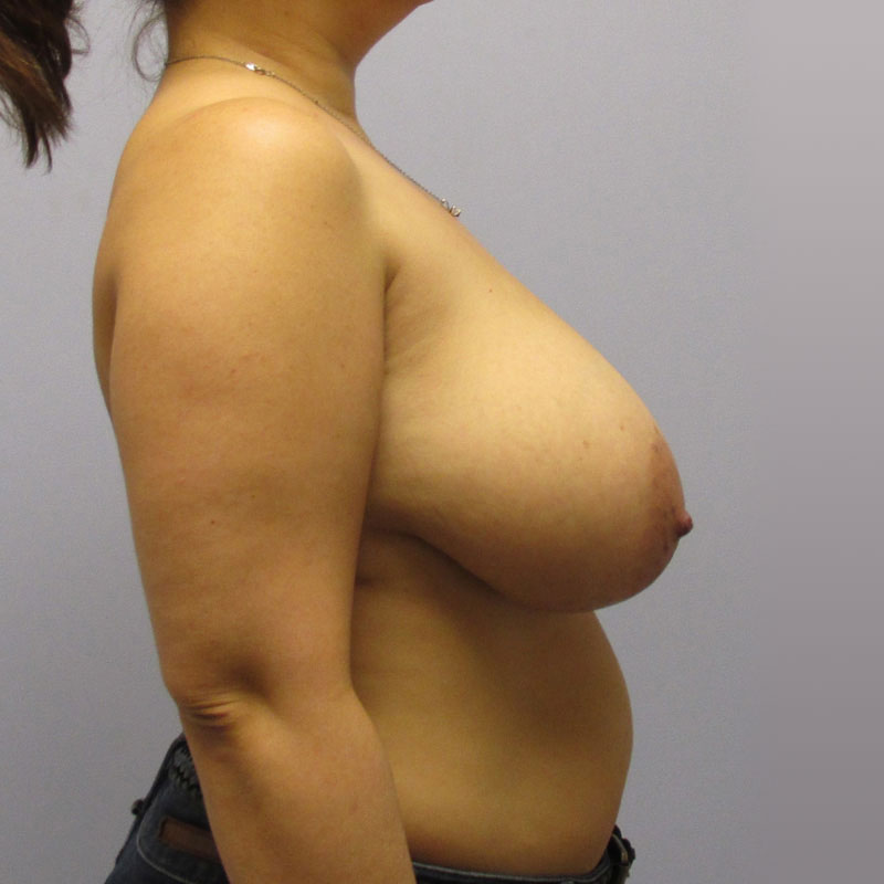 Breast Reduction Before & After Image