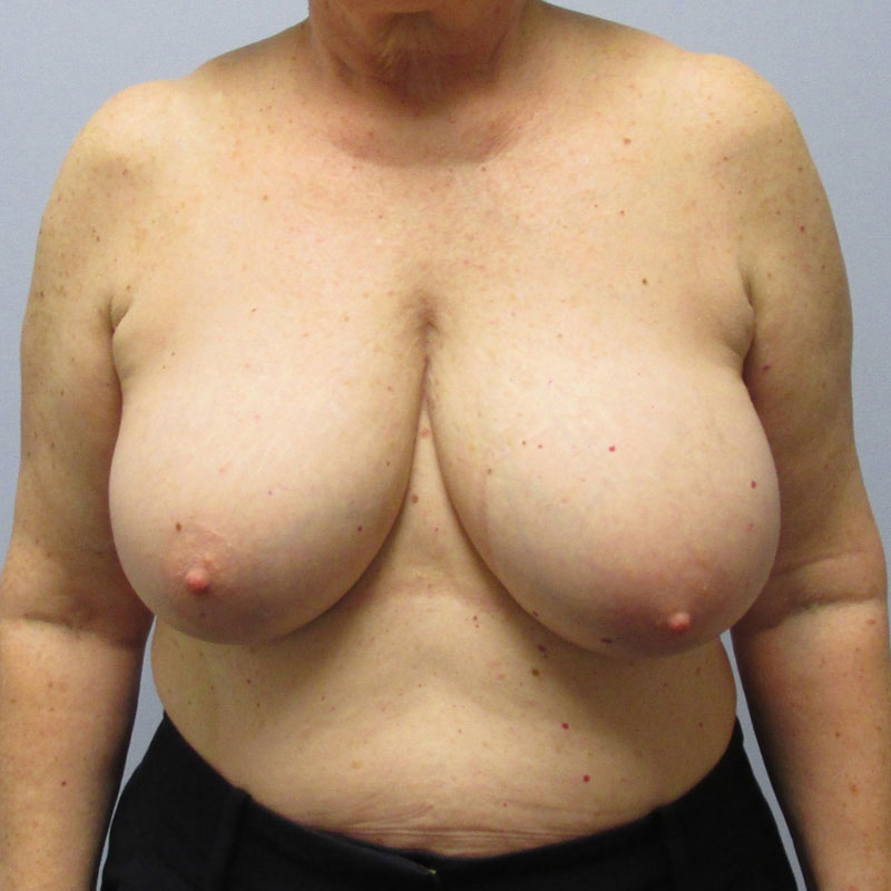 Breast Reduction Before & After Image