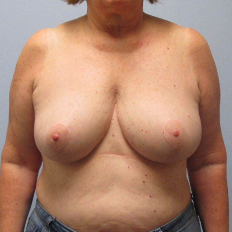 Breast Reduction Before & After Image