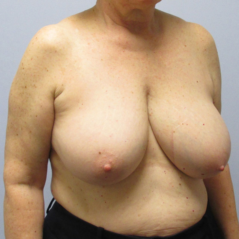 Breast Reduction Before & After Image