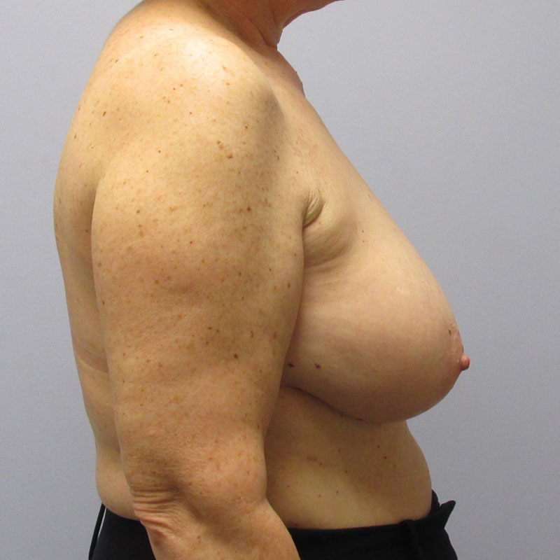 Breast Reduction Before & After Image