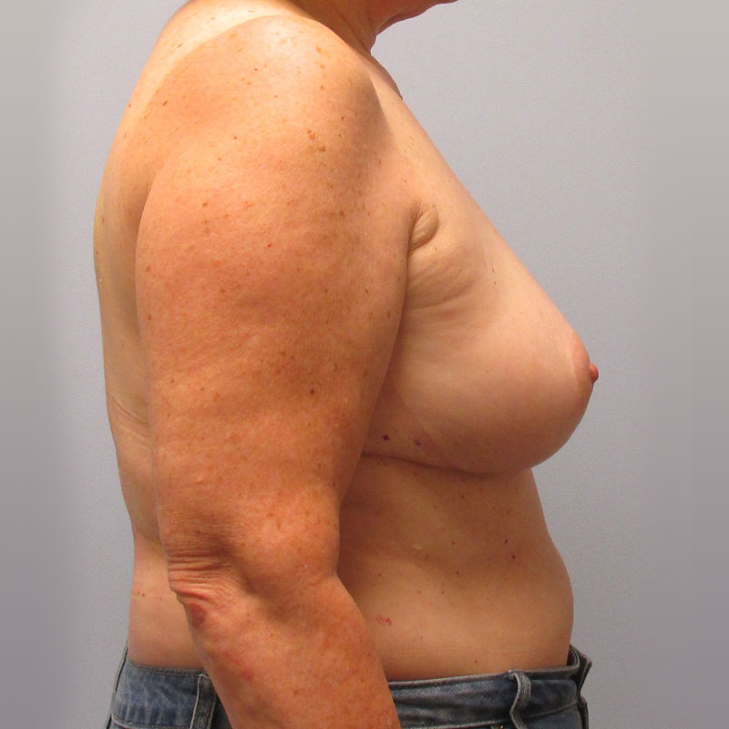 Breast Reduction Before & After Image