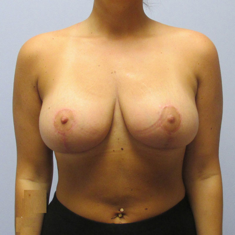 Breast Reduction Before & After Image