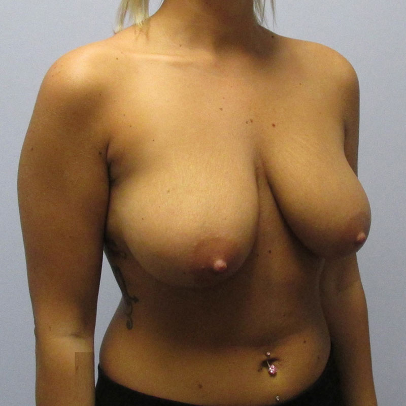 Breast Reduction Before & After Image