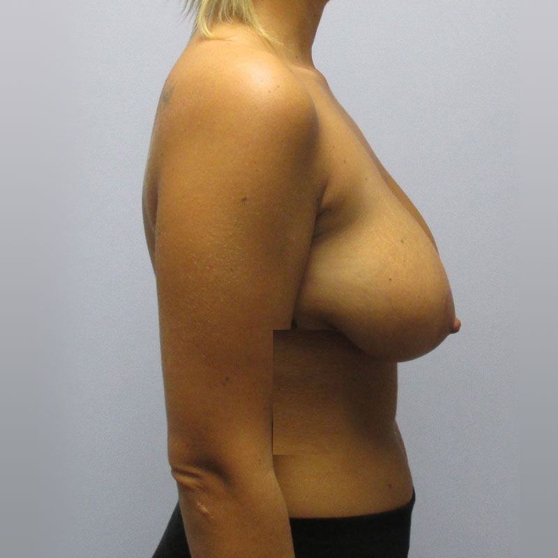 Breast Reduction Before & After Image