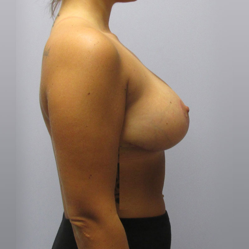 Breast Reduction Before & After Image