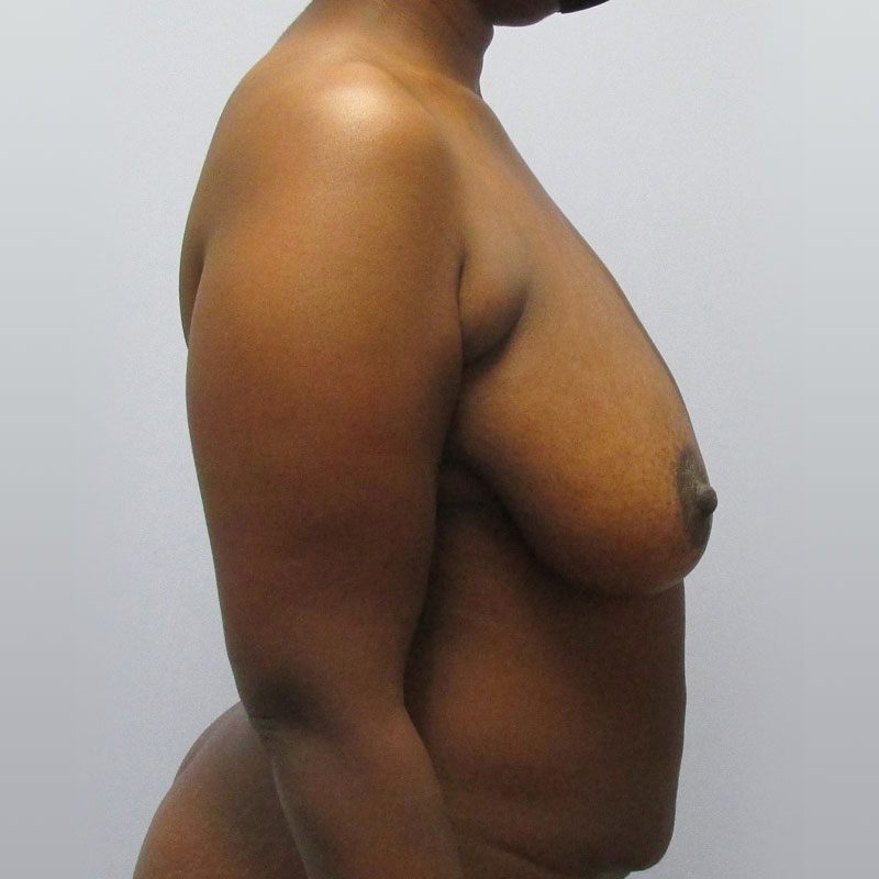 Breast Reduction Before & After Image