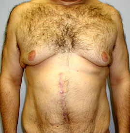 Gynecomastia Before & After Image