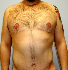 Gynecomastia Before & After Image