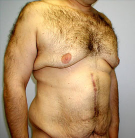 Gynecomastia Before & After Image