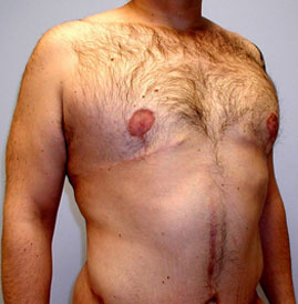 Gynecomastia Before & After Image