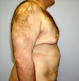 Gynecomastia Before & After Image