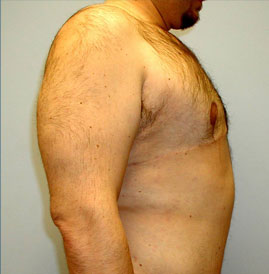 Gynecomastia Before & After Image